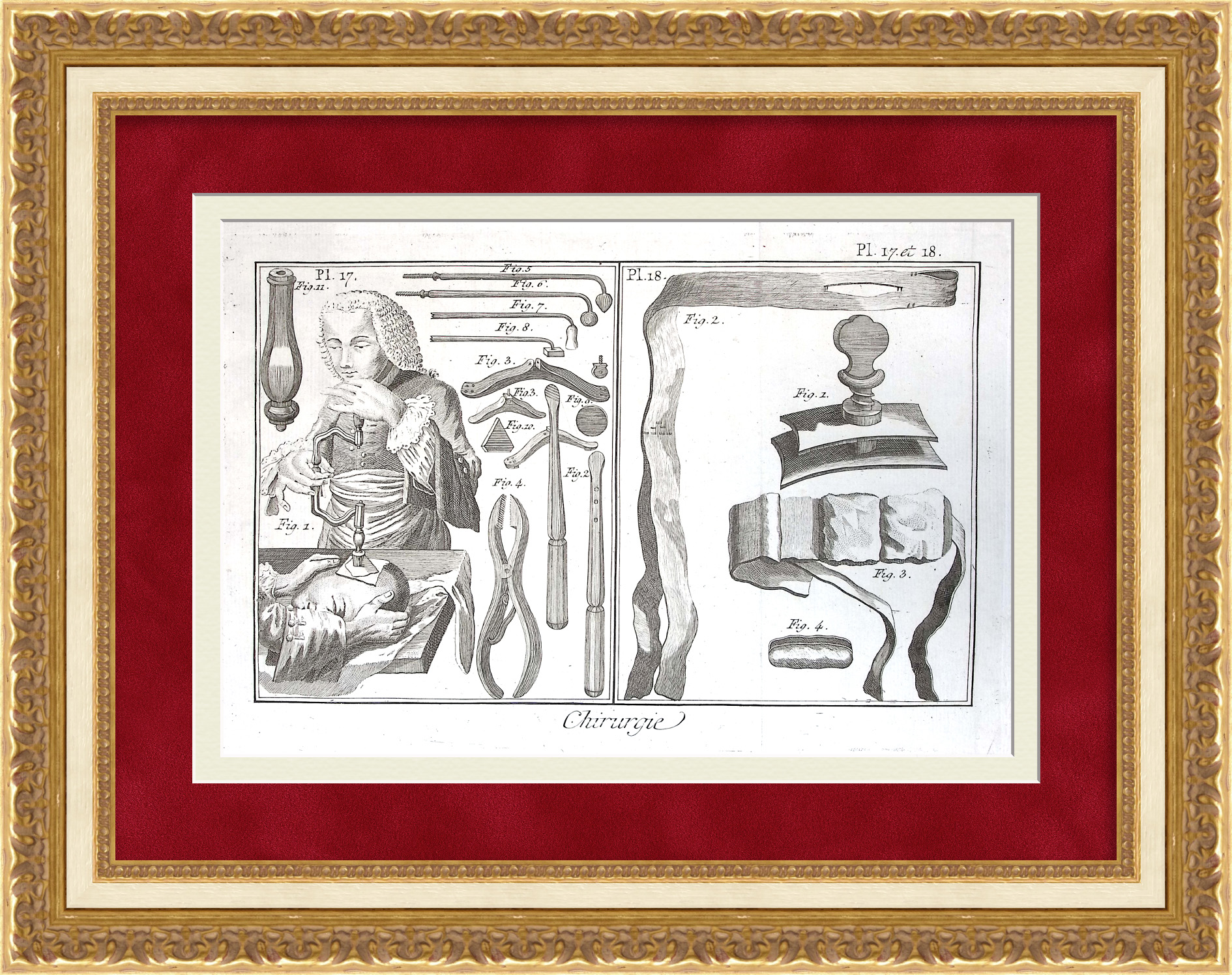 Трепанация черепа, нейрохирургия в 18 веке. Уникальная, старинная гравюра Трепанация черепа, нейрохирургия в 18 веке. Уникальная, старинная гравюра